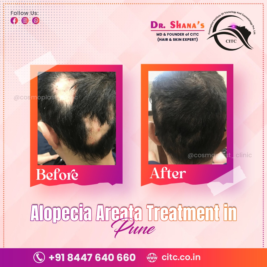 Alopecia Areata Treatment in Pune