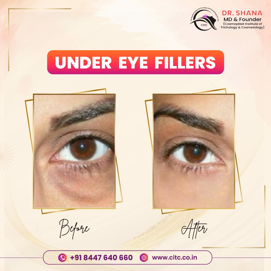 Effective Under Eye Treatment in Pune