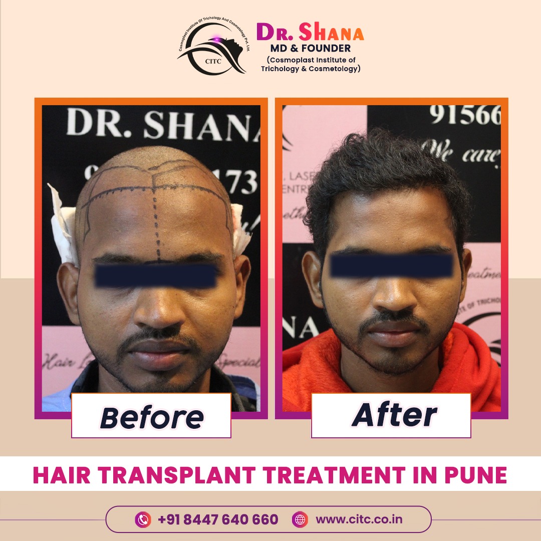 Advanced Hair Transplant Treatment in Pune