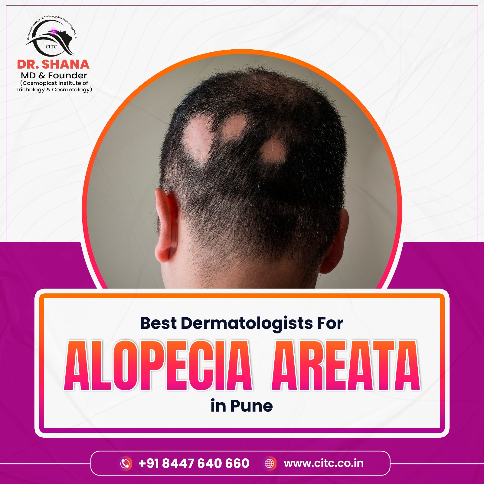 Best Dermatologists for Alopecia Areata in Pune