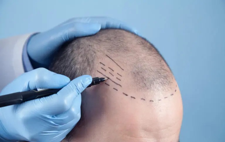 Hair transplant clinic in Pune